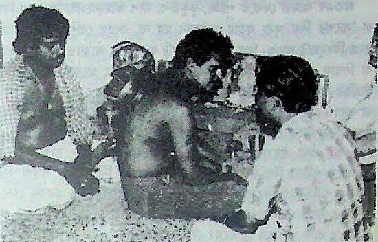 কুকুরে কামড়ানোর পর্ পিঠে থালা বসান হয়েছে।